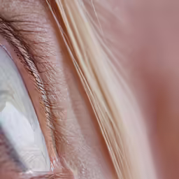 an iris lens with white streaks on the iris area